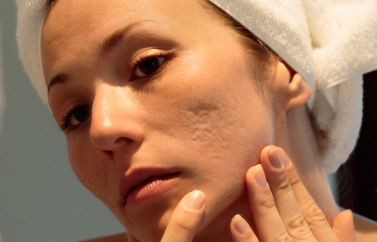 What Is Acne Scarring And How To Treat It?