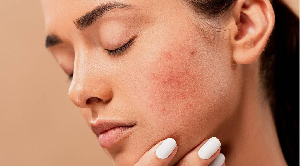 Identify and Treat Skin Redness