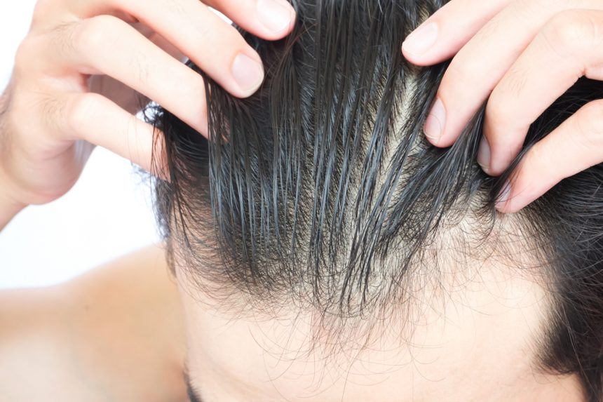 Let's Talk About Androgenetic Alopecia