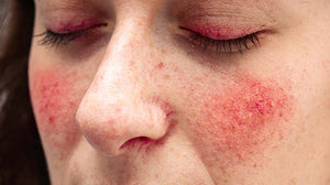 Understanding Of Rosacea